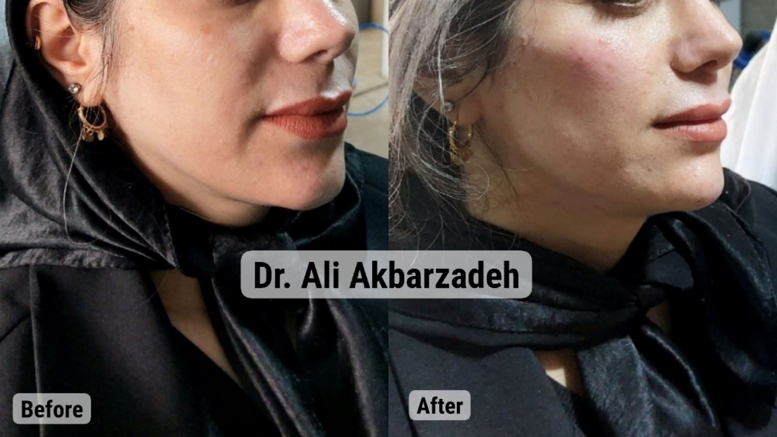 قبل و بعد از فیلر گونه و زاویهی فک