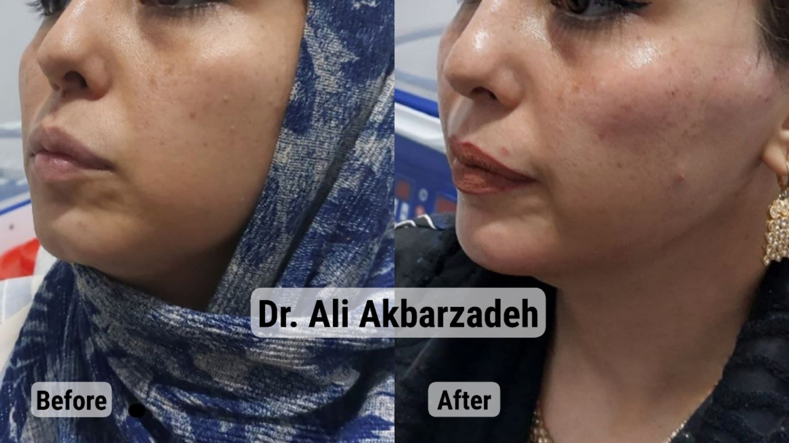 قبل و بعد از حجمدهی گونه