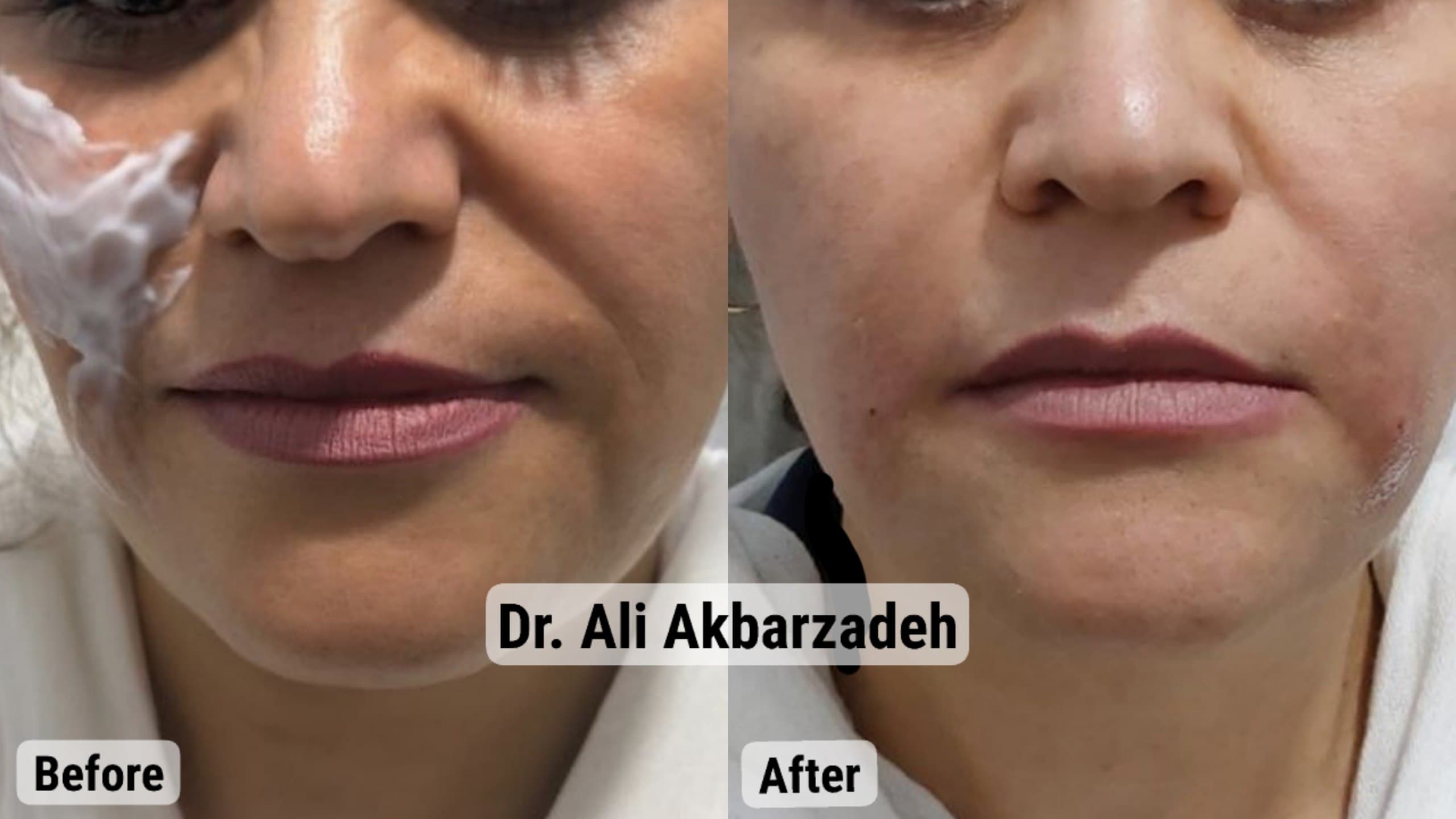 قبل و بعد از اصلاح خط خنده و حجمدهی لب